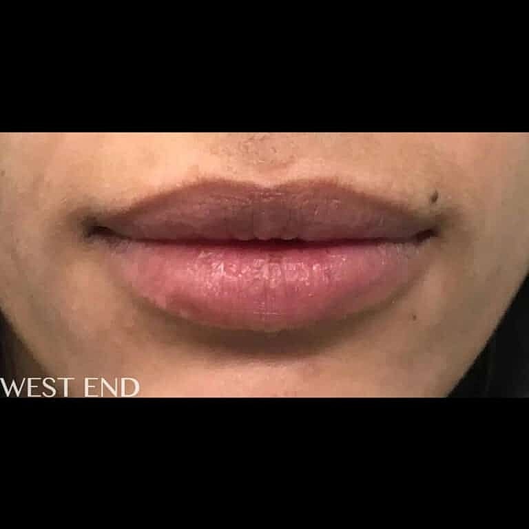 Dermal Fillers Before & After