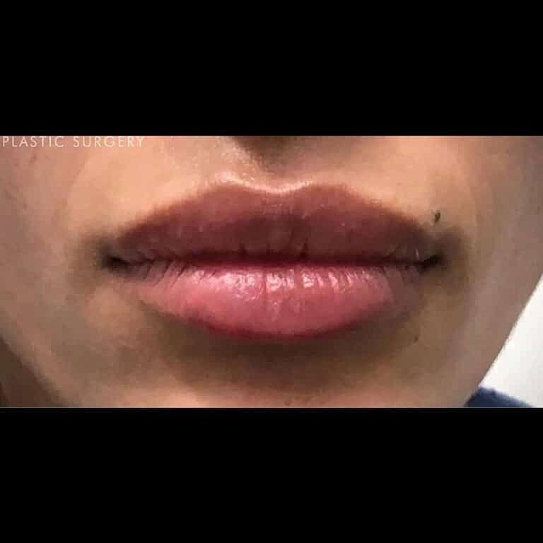 Dermal Fillers Before & After