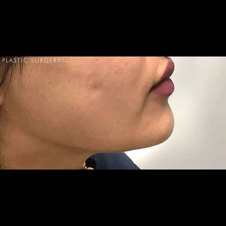 Dermal Fillers Before & After