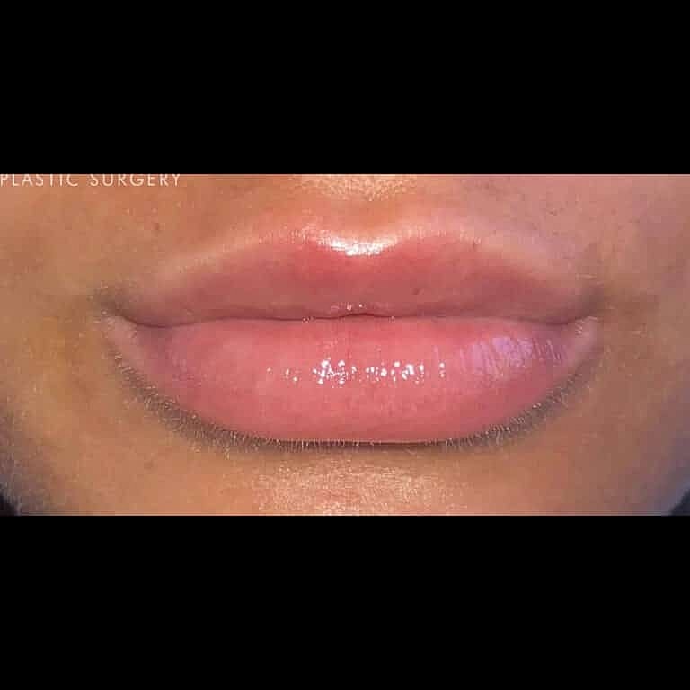 Dermal Fillers Before & After