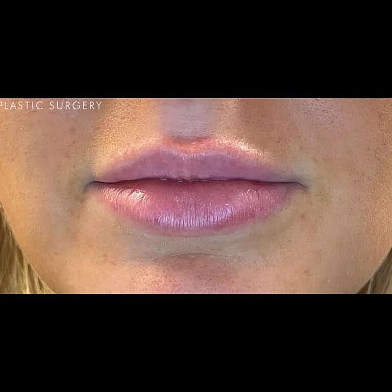Dermal Fillers Before & After