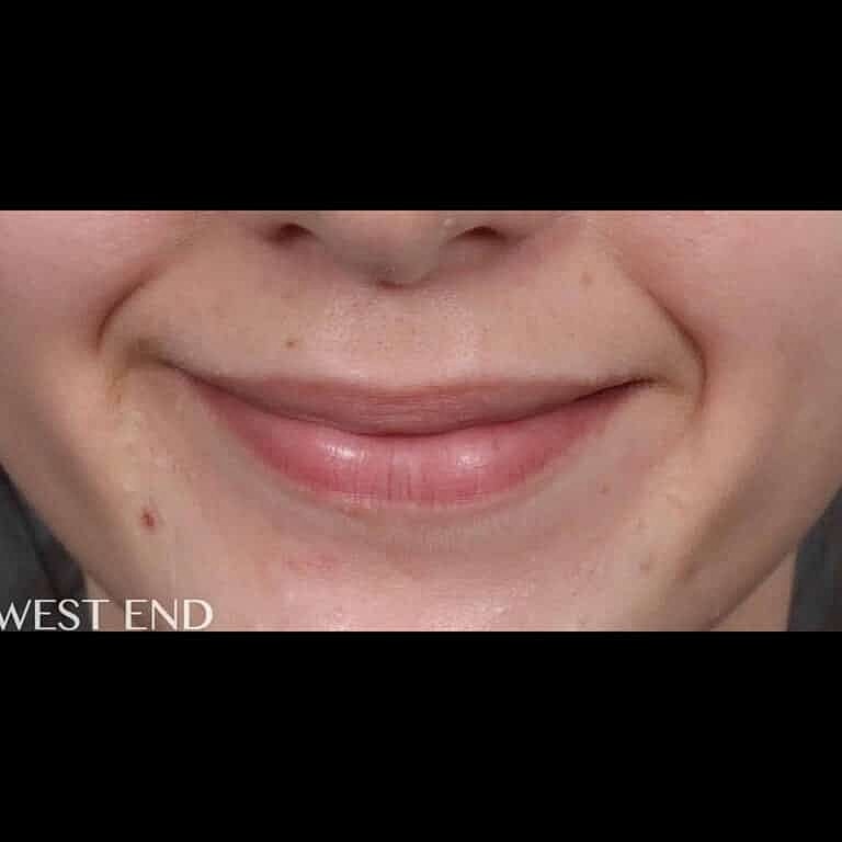 Dermal Fillers Before & After