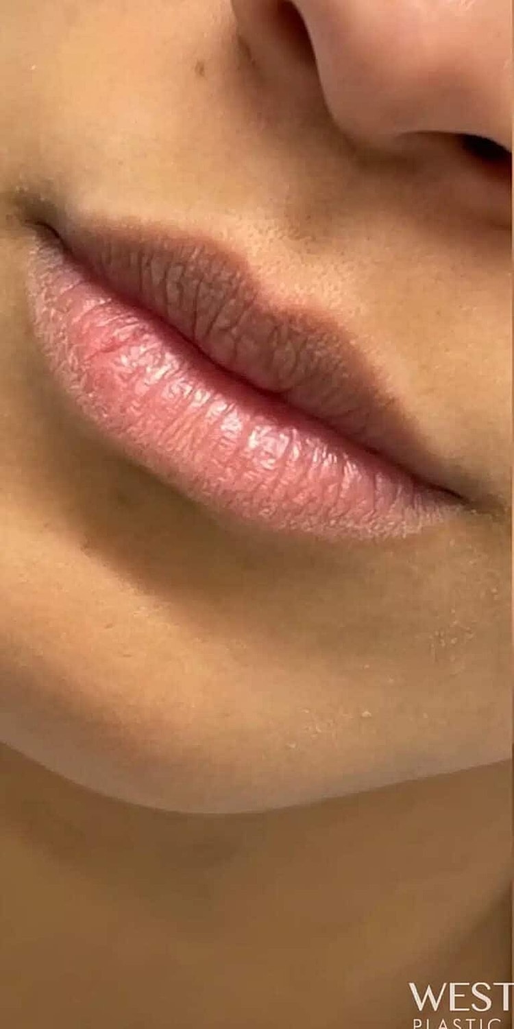 Dermal Fillers Before & After