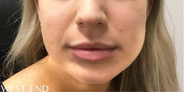 Dermal Fillers Before & After