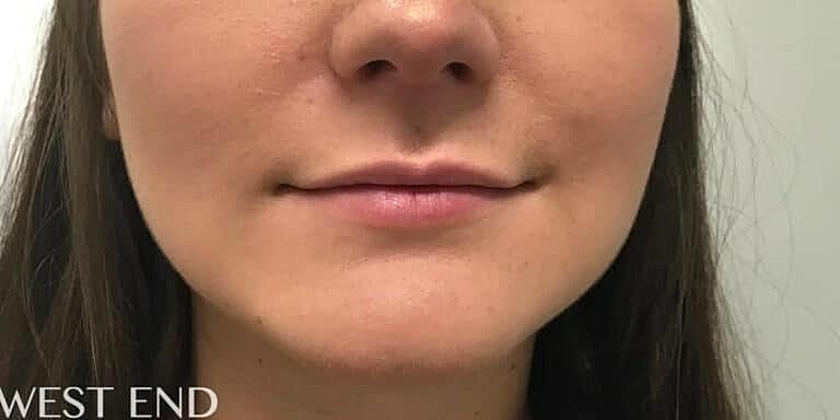 Dermal Fillers Before & After