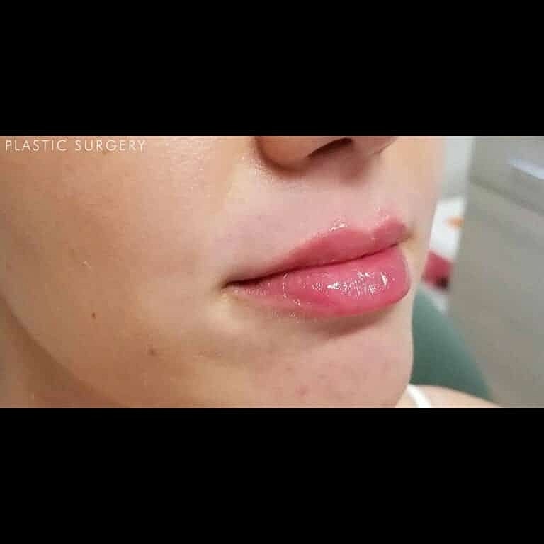 Dermal Fillers Before & After