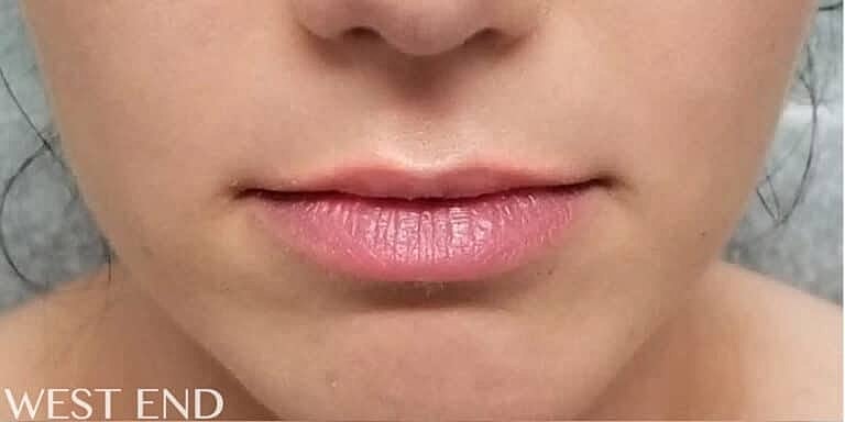 Dermal Fillers Before & After