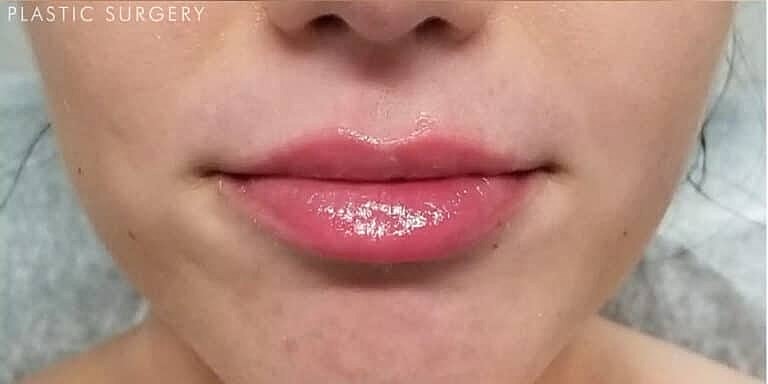 Dermal Fillers Before & After
