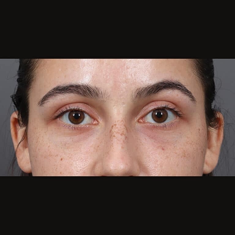 Dermal Fillers Before & After