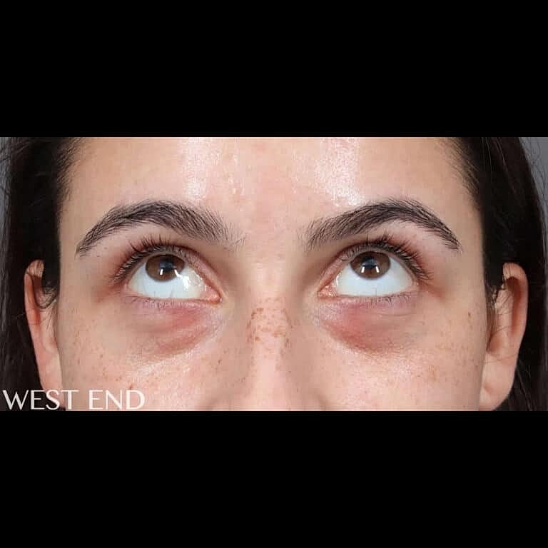 Dermal Fillers Before & After