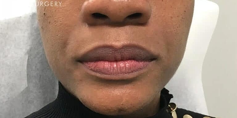 Dermal Fillers Before & After