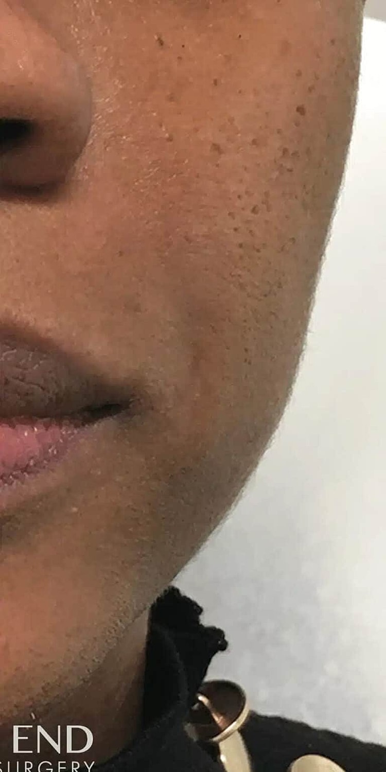 Dermal Fillers Before & After