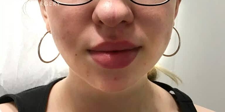 Dermal Fillers Before & After
