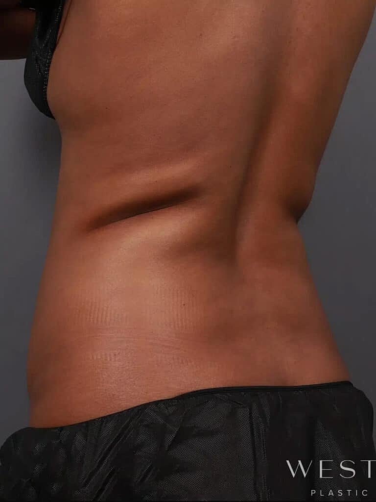 Coolsculpting Before & After