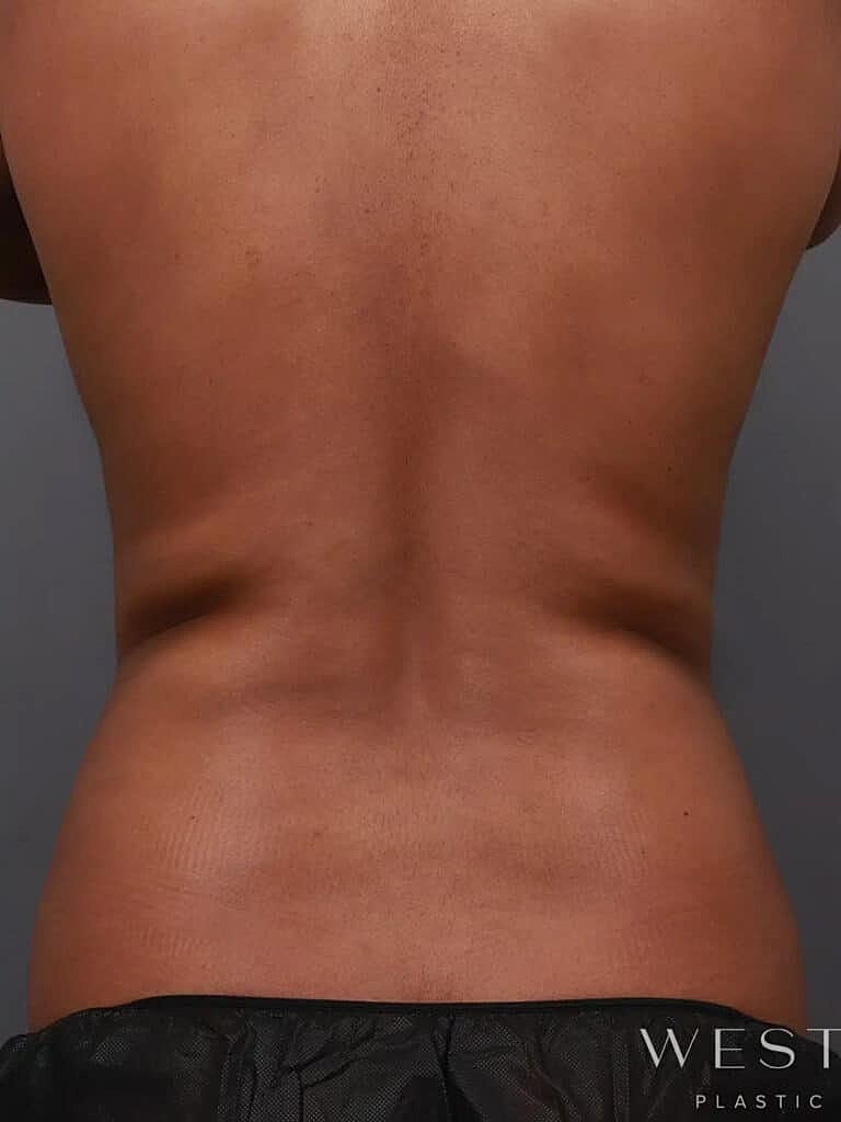 Coolsculpting Before & After