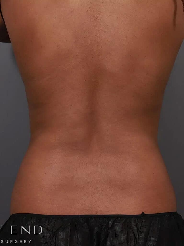Coolsculpting Before & After