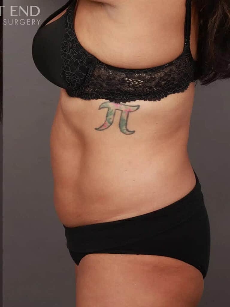 Coolsculpting Before & After