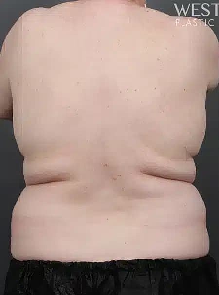 Coolsculpting Before & After