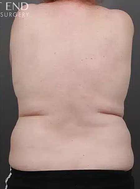 Coolsculpting Before & After