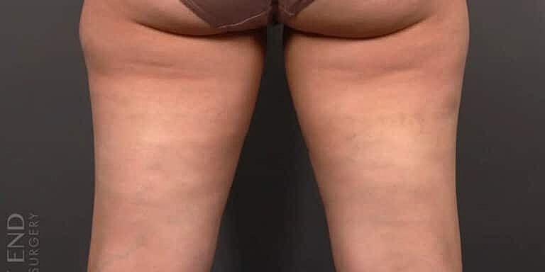 Coolsculpting Before & After