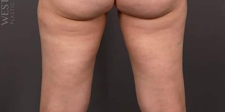 Coolsculpting Before & After
