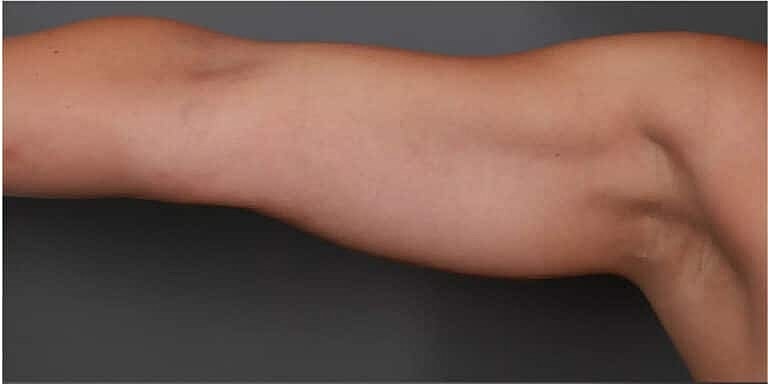 Coolsculpting Before & After