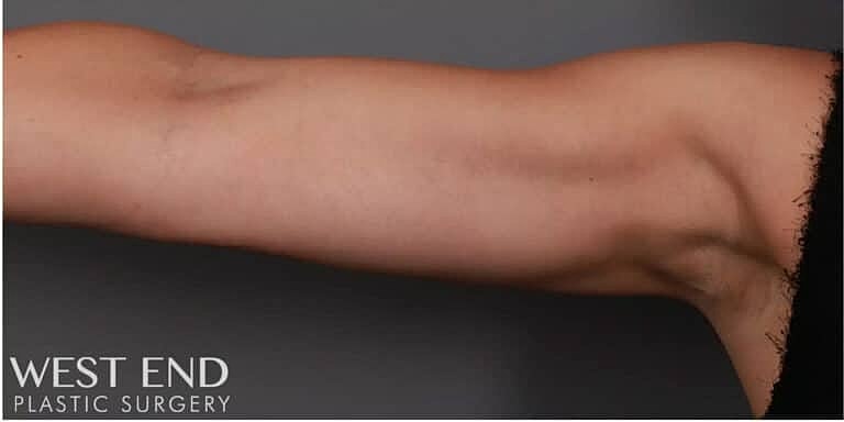 Coolsculpting Before & After