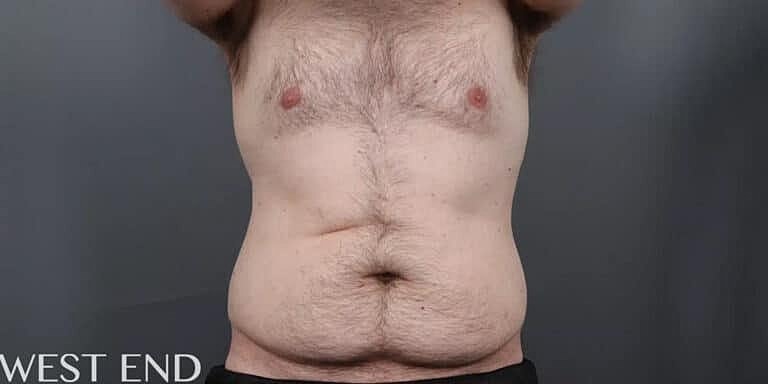 Coolsculpting Before & After
