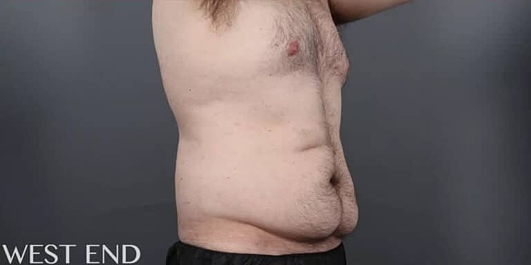 Coolsculpting Before & After