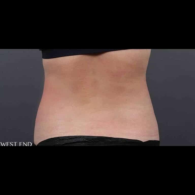 Coolsculpting Before & After