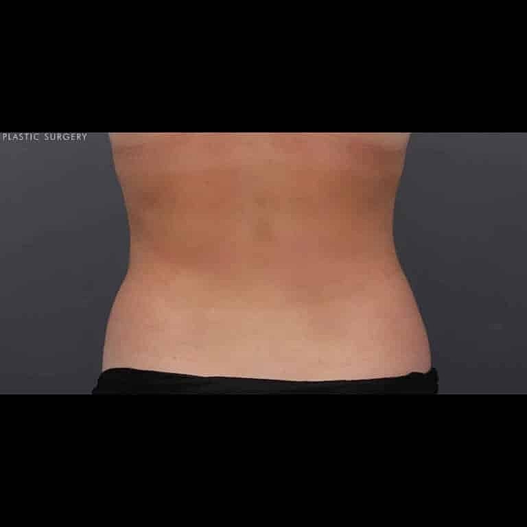 Coolsculpting Before & After