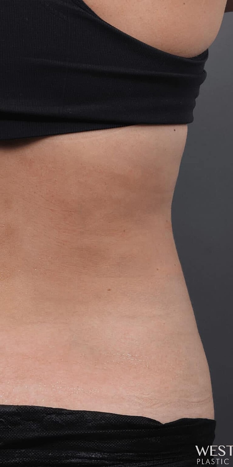 Coolsculpting Before & After