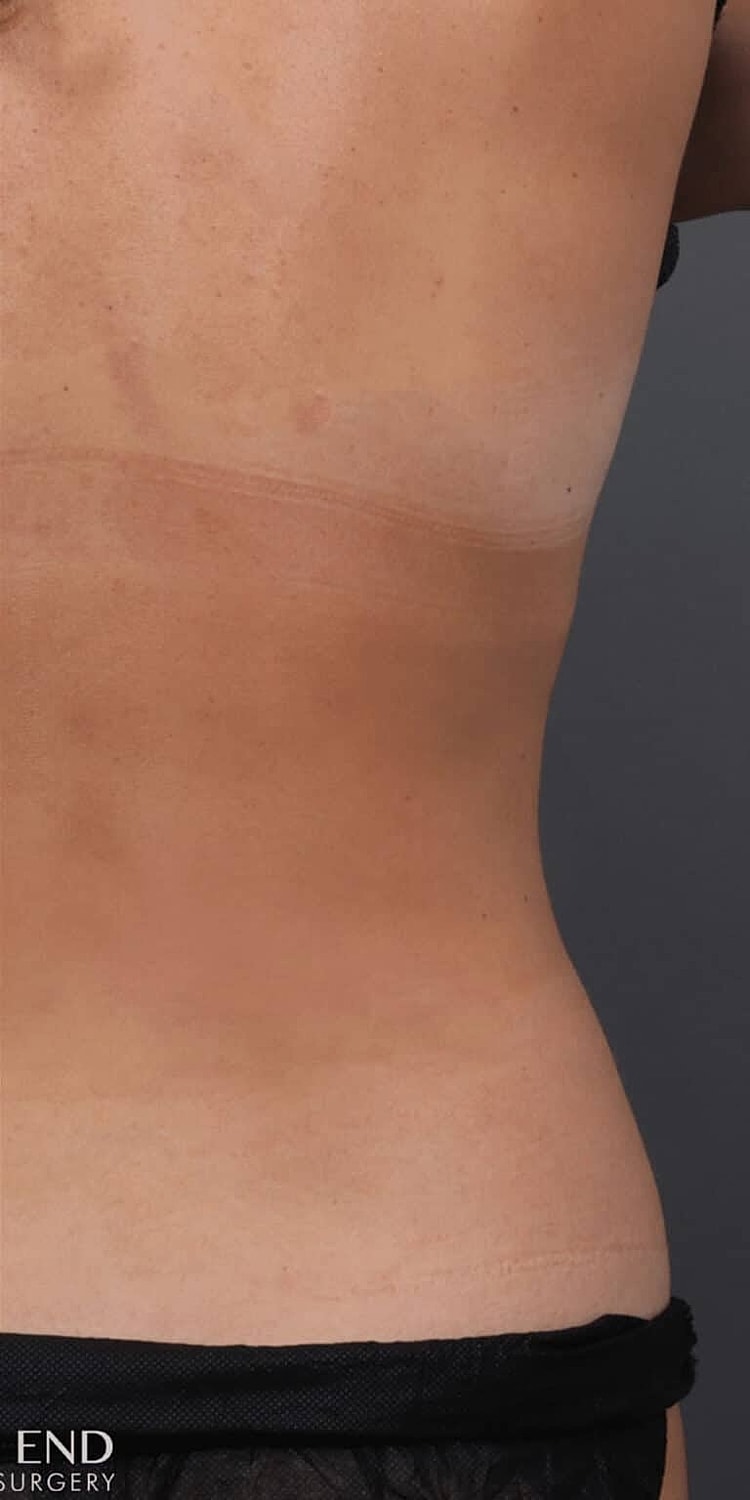 Coolsculpting Before & After