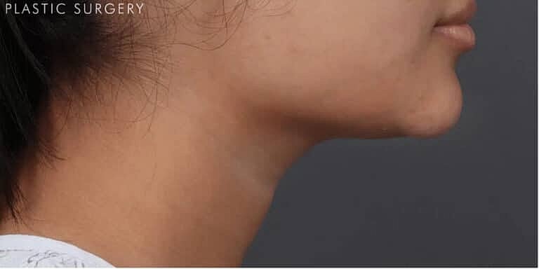 Coolsculpting Before & After