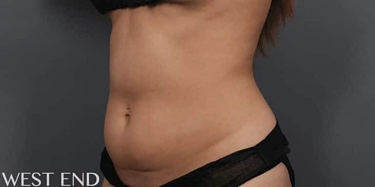 Coolsculpting Before & After