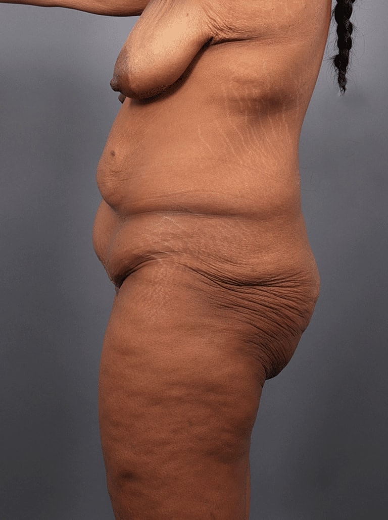 Post Weight Loss Before & After