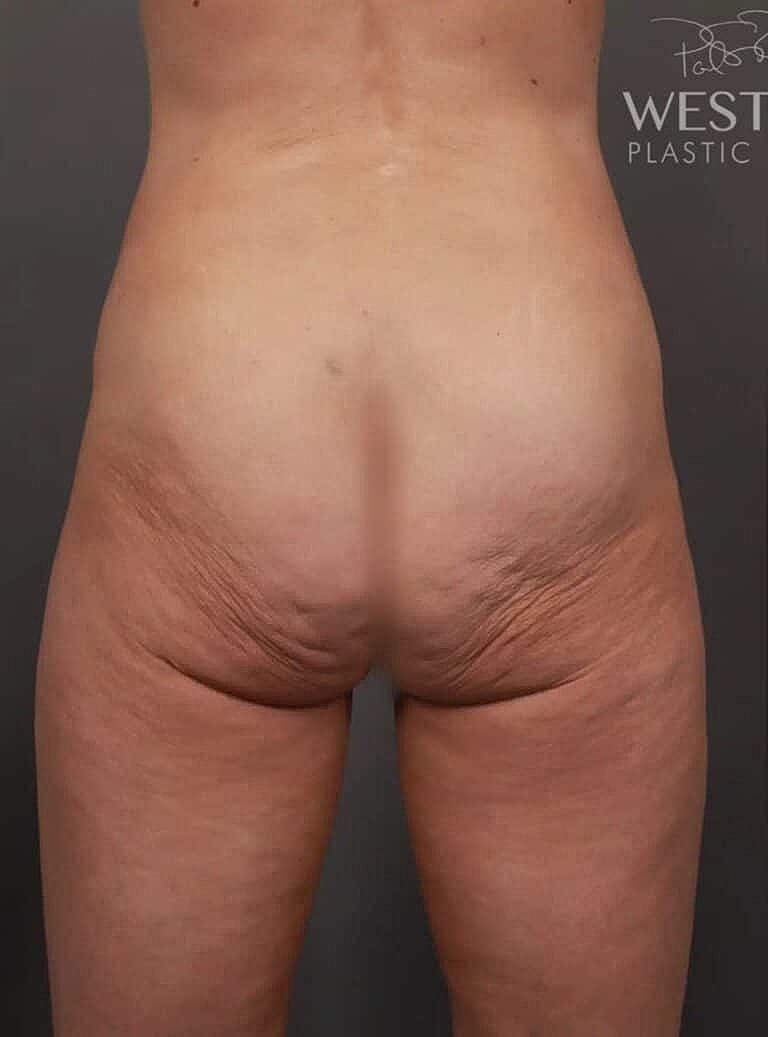 Post Weight Loss Before & After