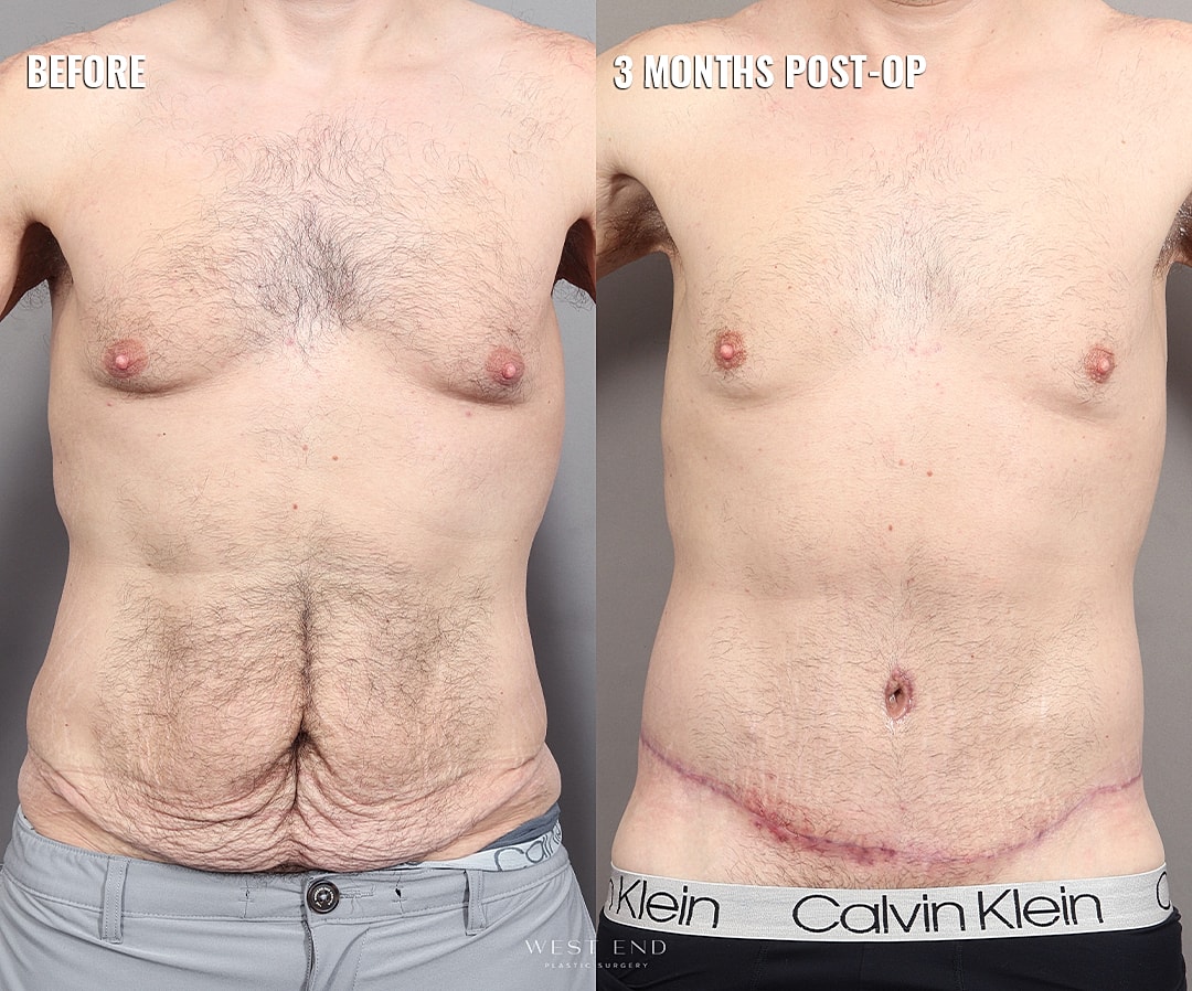 Before and after surgery transformation photos.