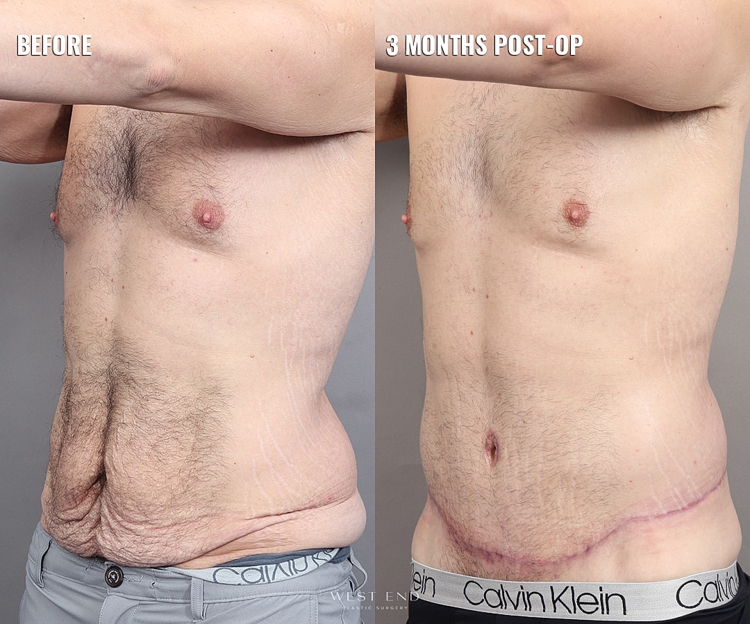 Before and after photos of post-operative transformation.