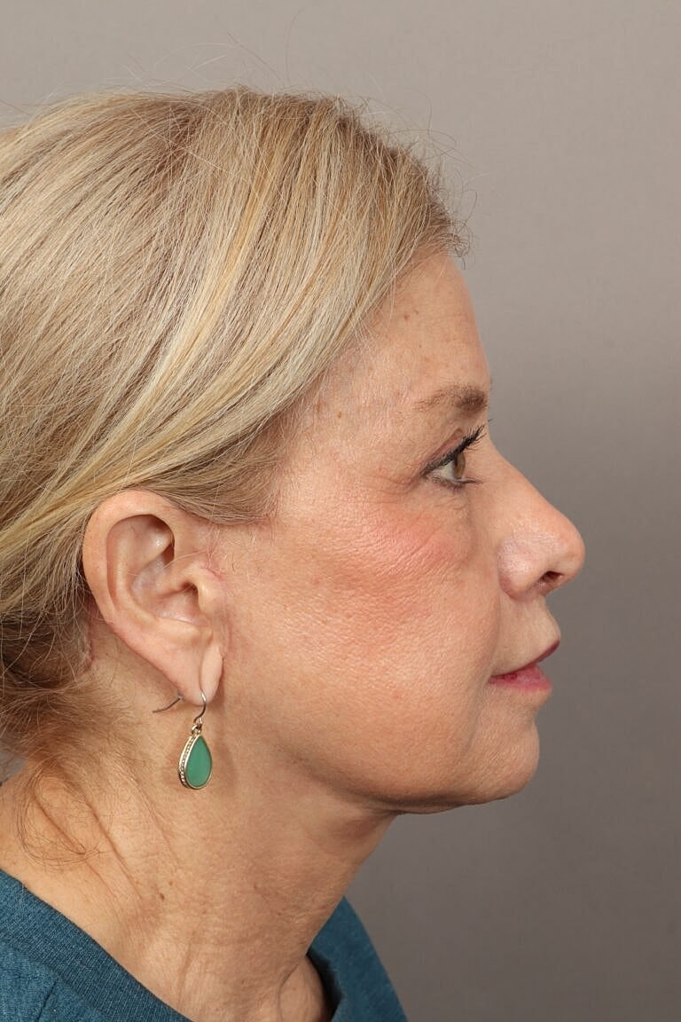 Facial Fat Transfer Before & After