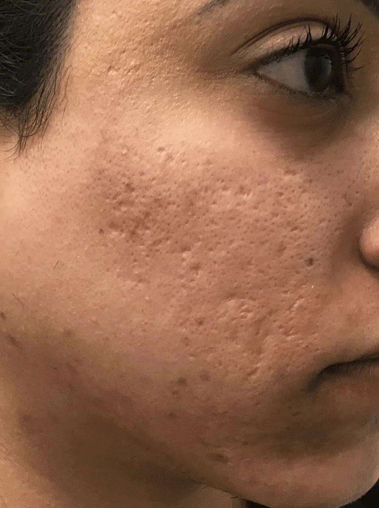 Facial Fat Transfer Before & After