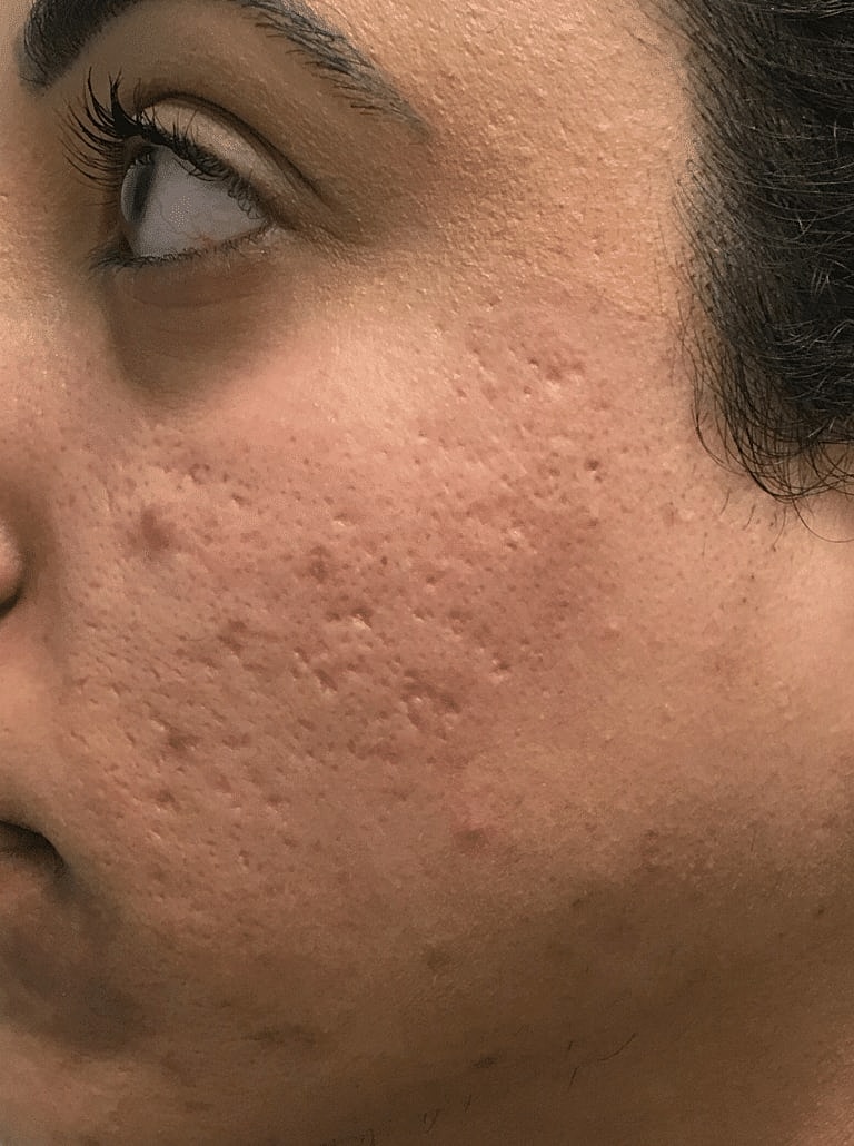 Facial Fat Transfer Before & After