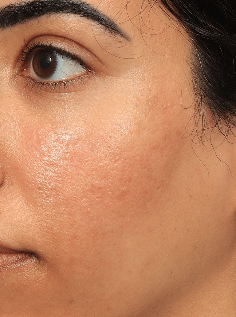 Facial Fat Transfer Before & After