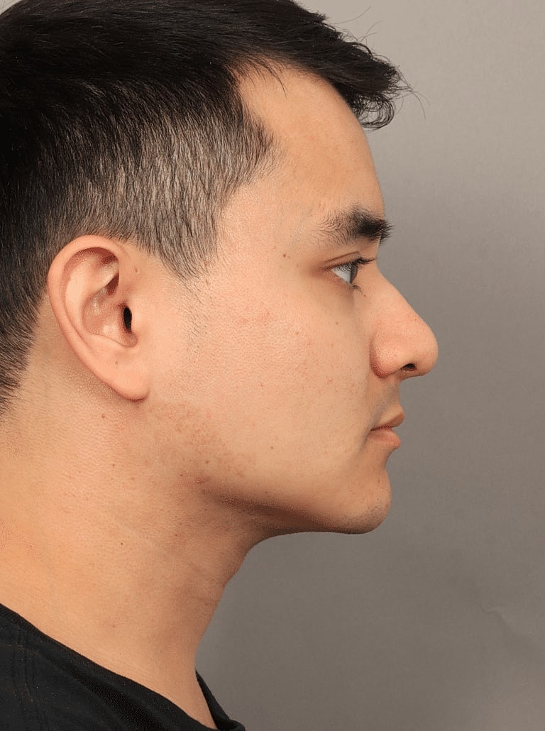 Facial Fat Transfer Before & After