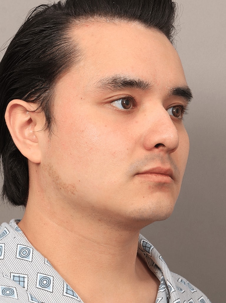 Facial Fat Transfer Before & After