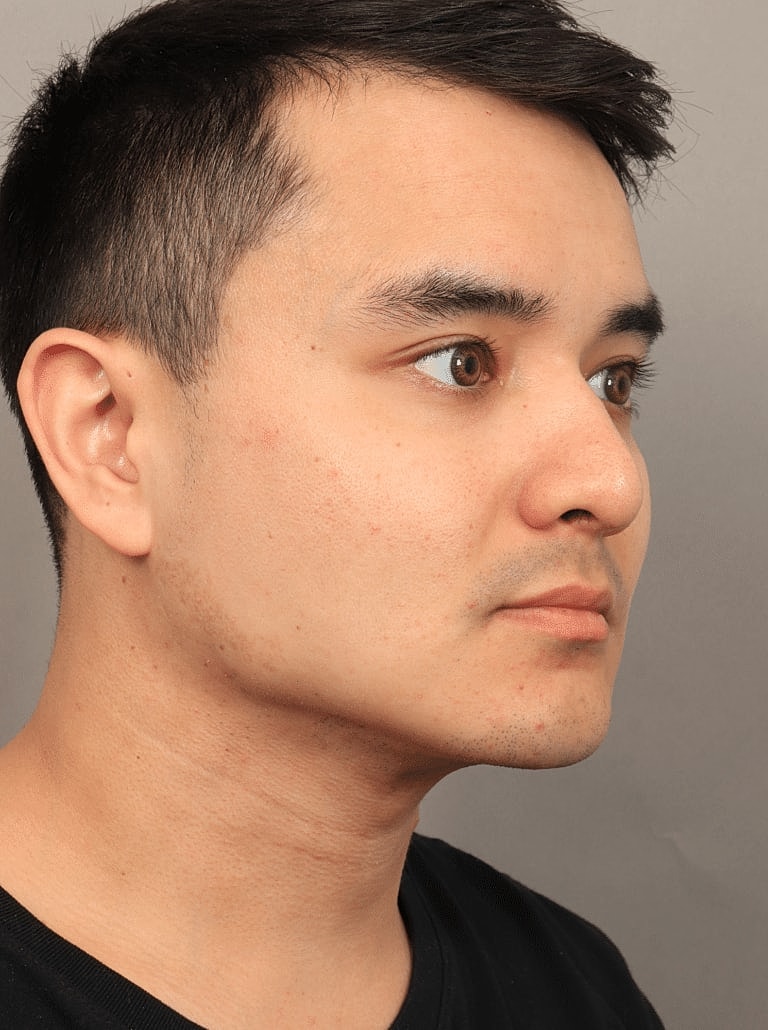 Facial Fat Transfer Before & After