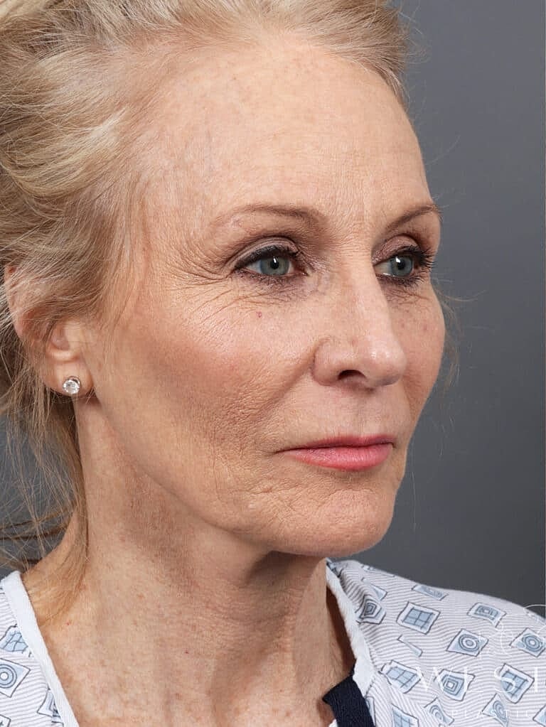 Facial Fat Transfer Before & After