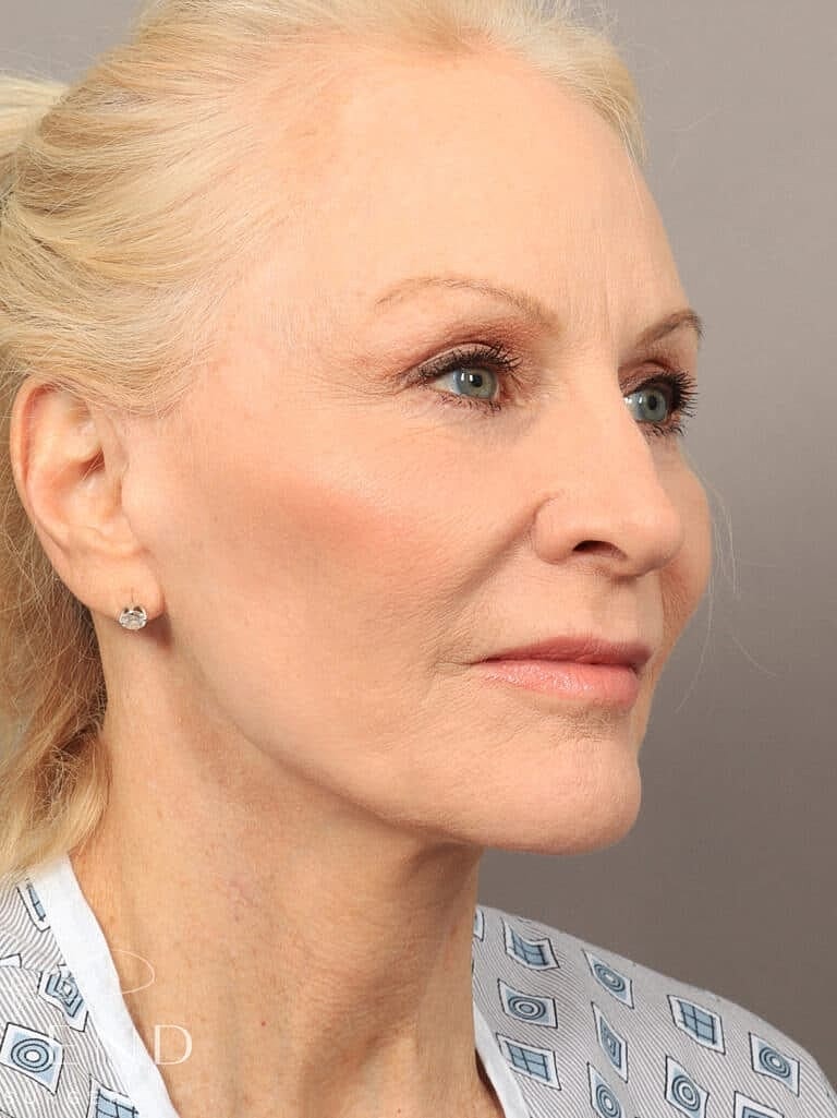 Facial Fat Transfer Before & After