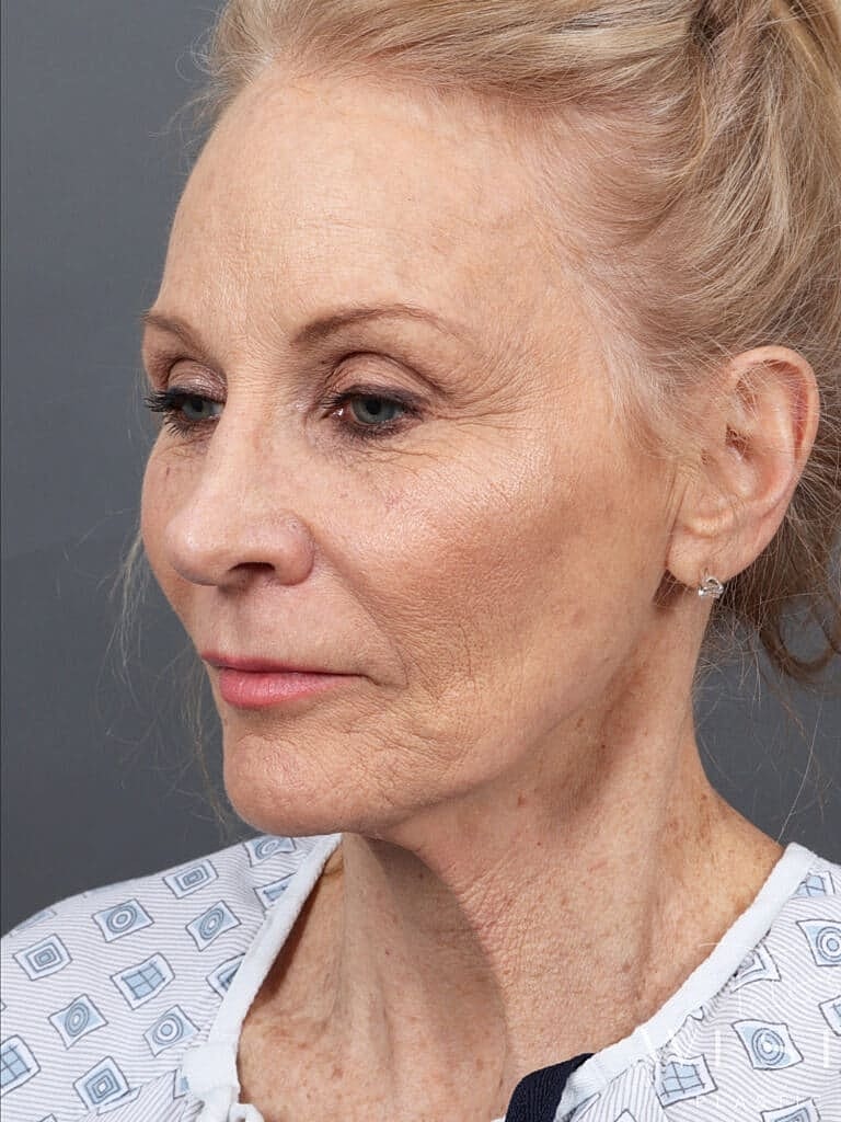 Facial Fat Transfer Before & After