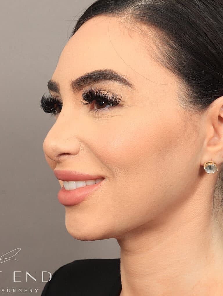 Facial Fat Transfer Before & After